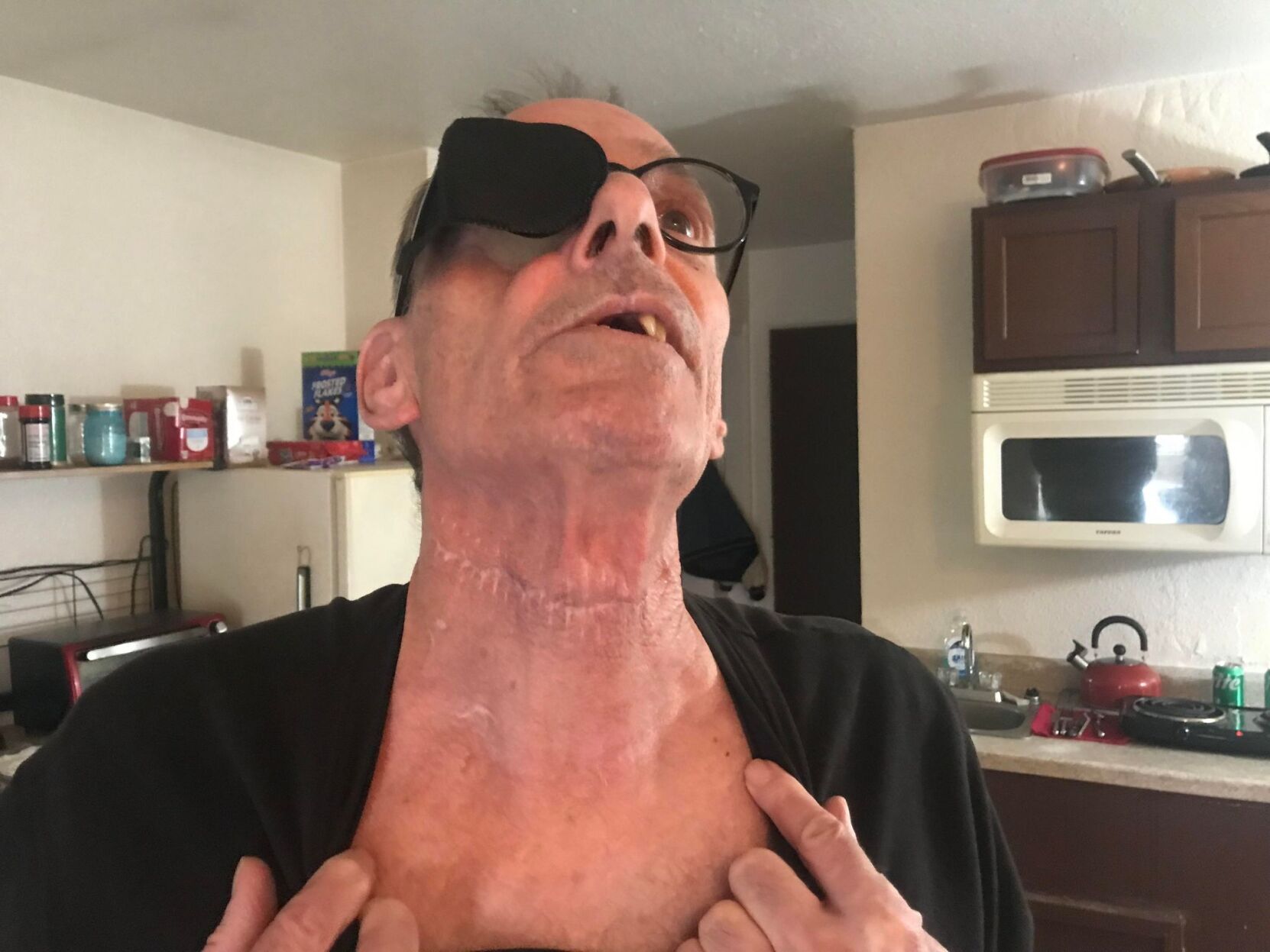 Cancer survivor wakes up from surgery without his right eye and confused by multiple scars